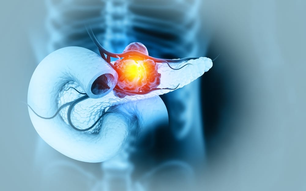 An overview of pancreatic ductal adenocarcinoma