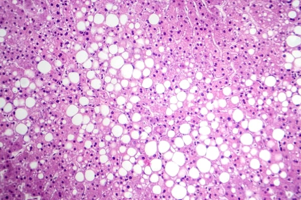 An overview of steatosis